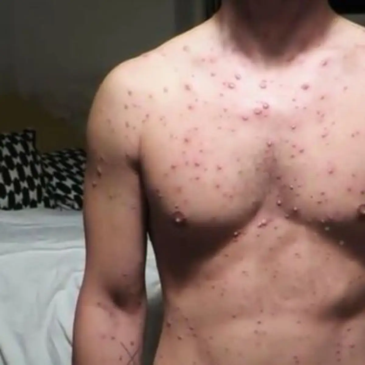 Cacar Air Pada Orang Dewasa Kenapa Lebih Berisiko