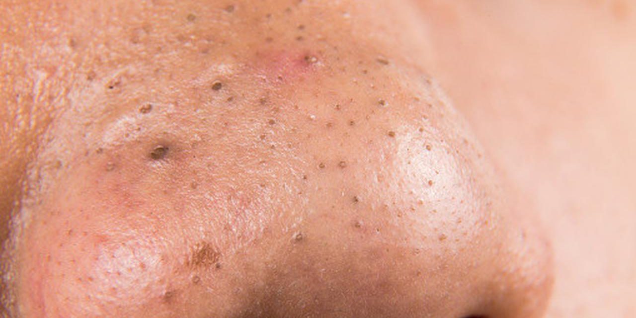 Akhirnya! 5 Rahasia Hempas Komedo Hitam Selamanya