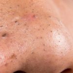 Akhirnya! 5 Rahasia Hempas Komedo Hitam Selamanya