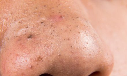 Akhirnya! 5 Rahasia Hempas Komedo Hitam Selamanya