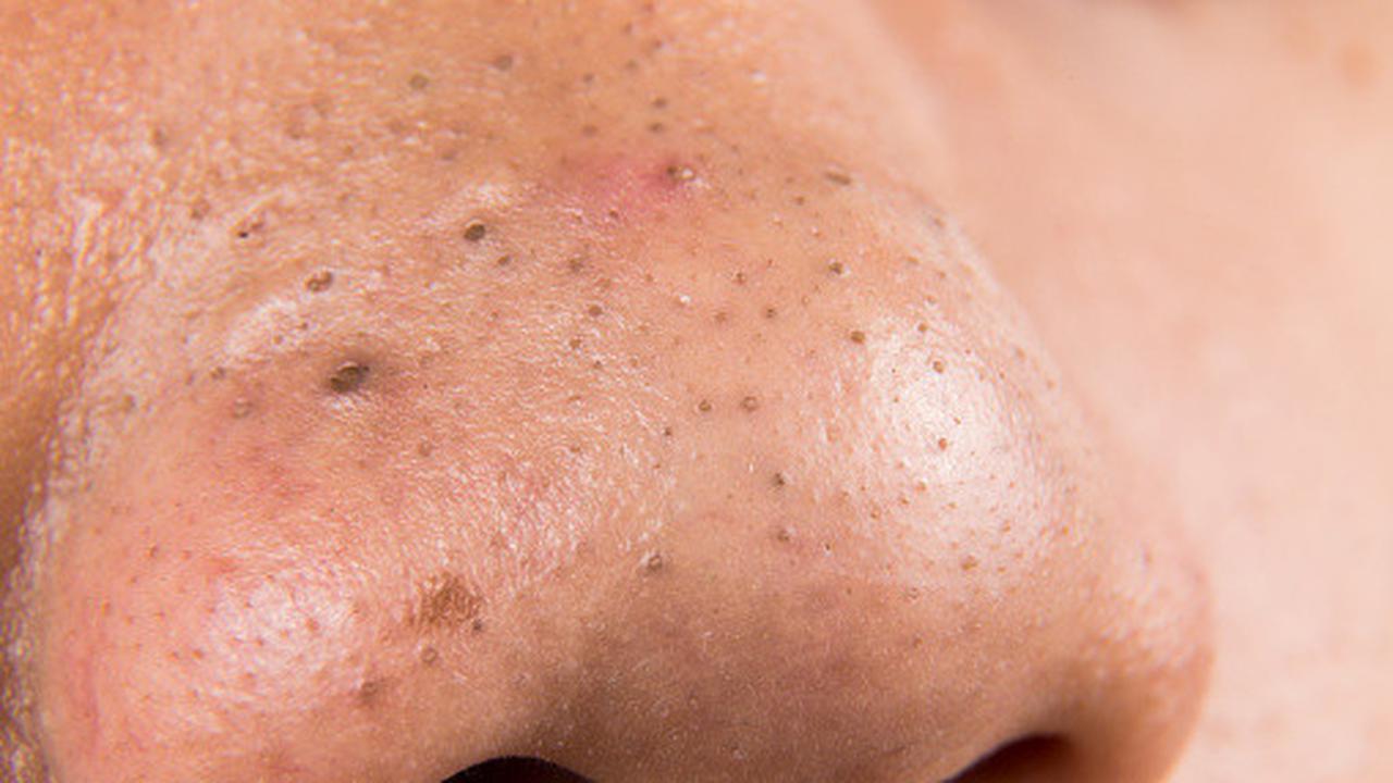 Akhirnya! 5 Rahasia Hempas Komedo Hitam Selamanya