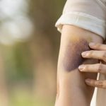Efek Samping Suntik Putih Bagi Kesehatan