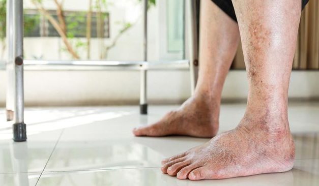 Tanda Awal Penyakit Gula di Usia Muda